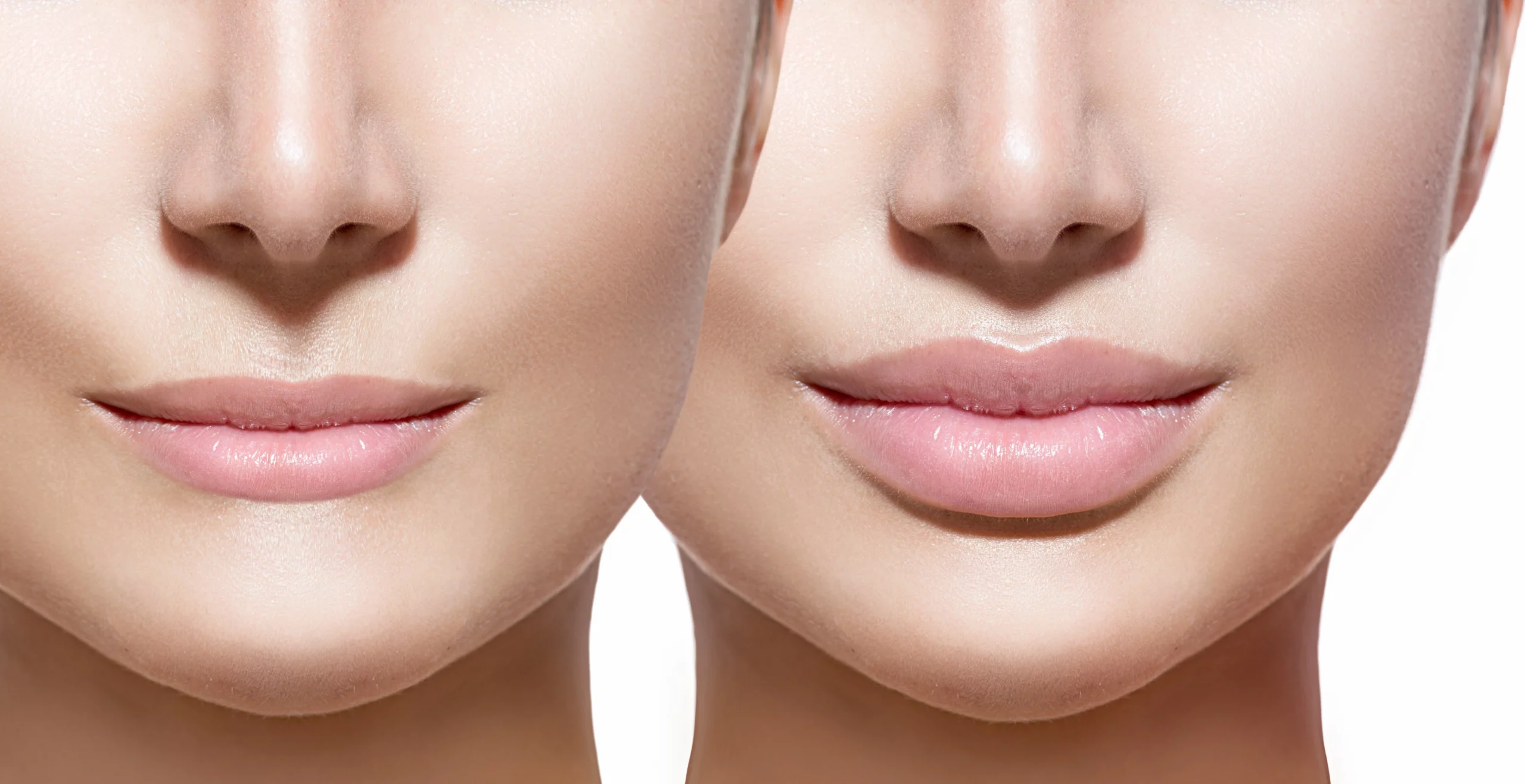 Lip fillers Bournemouth & Poole - before and after image