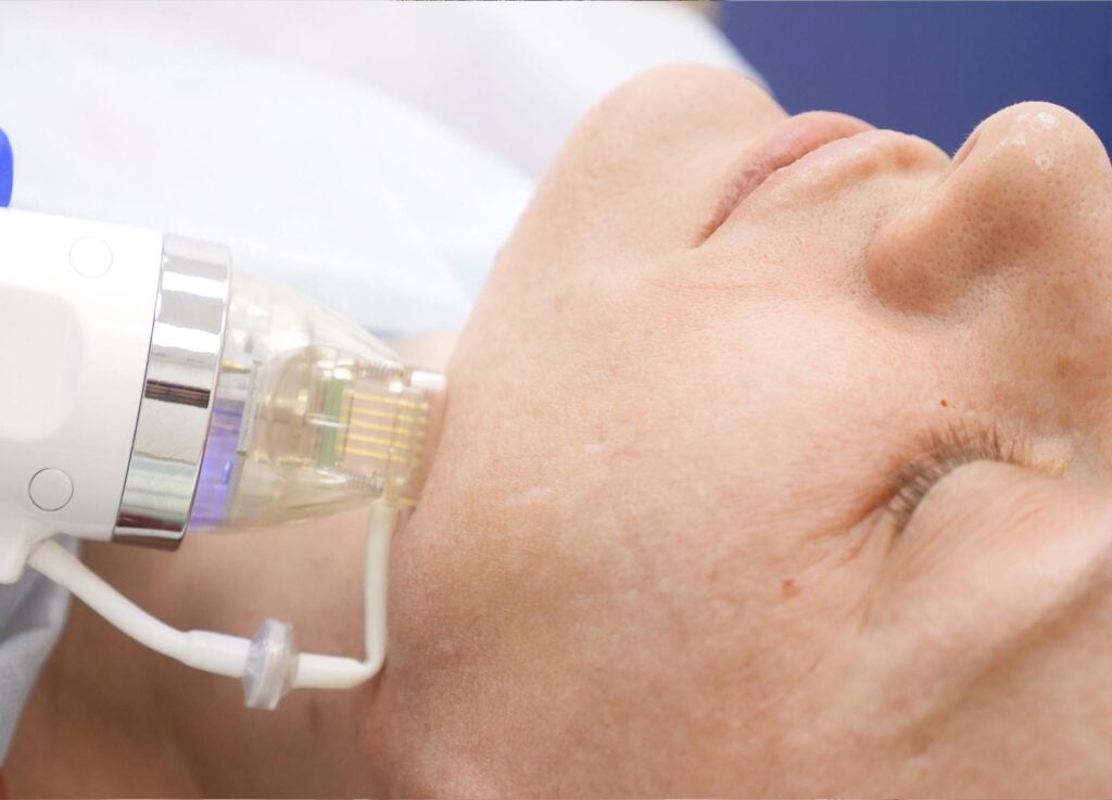 RS_RF-microneedling-guide RF Microneedling Bournemouth & Poole